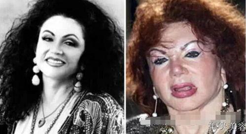 明星整形 失败案例,美丽背后的风险与反思